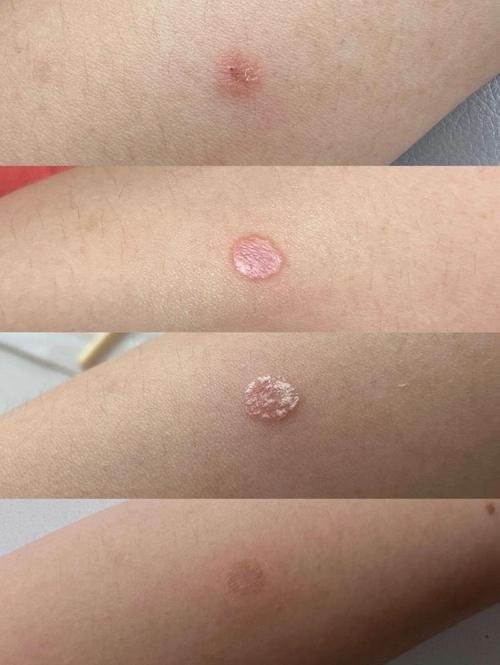 视频：猫咪的毛结块是猫癣吗？