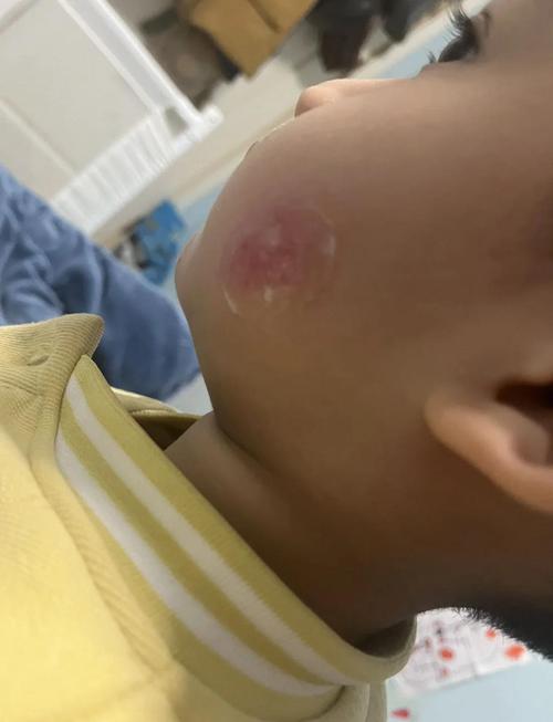 视频：猫咪脸部皮肤发炎是湿疹吗？